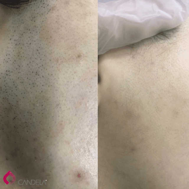 dark hair laser hair removal