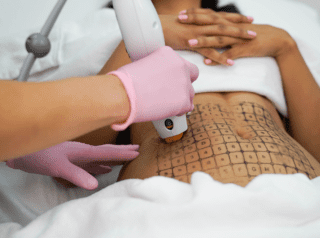 Thermage skin tightening treatments in London