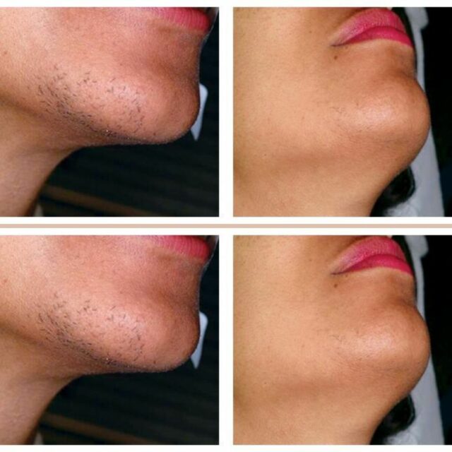 Laser hair removal clinic near EC4
