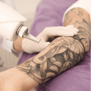 Laser Tattoo Removal London