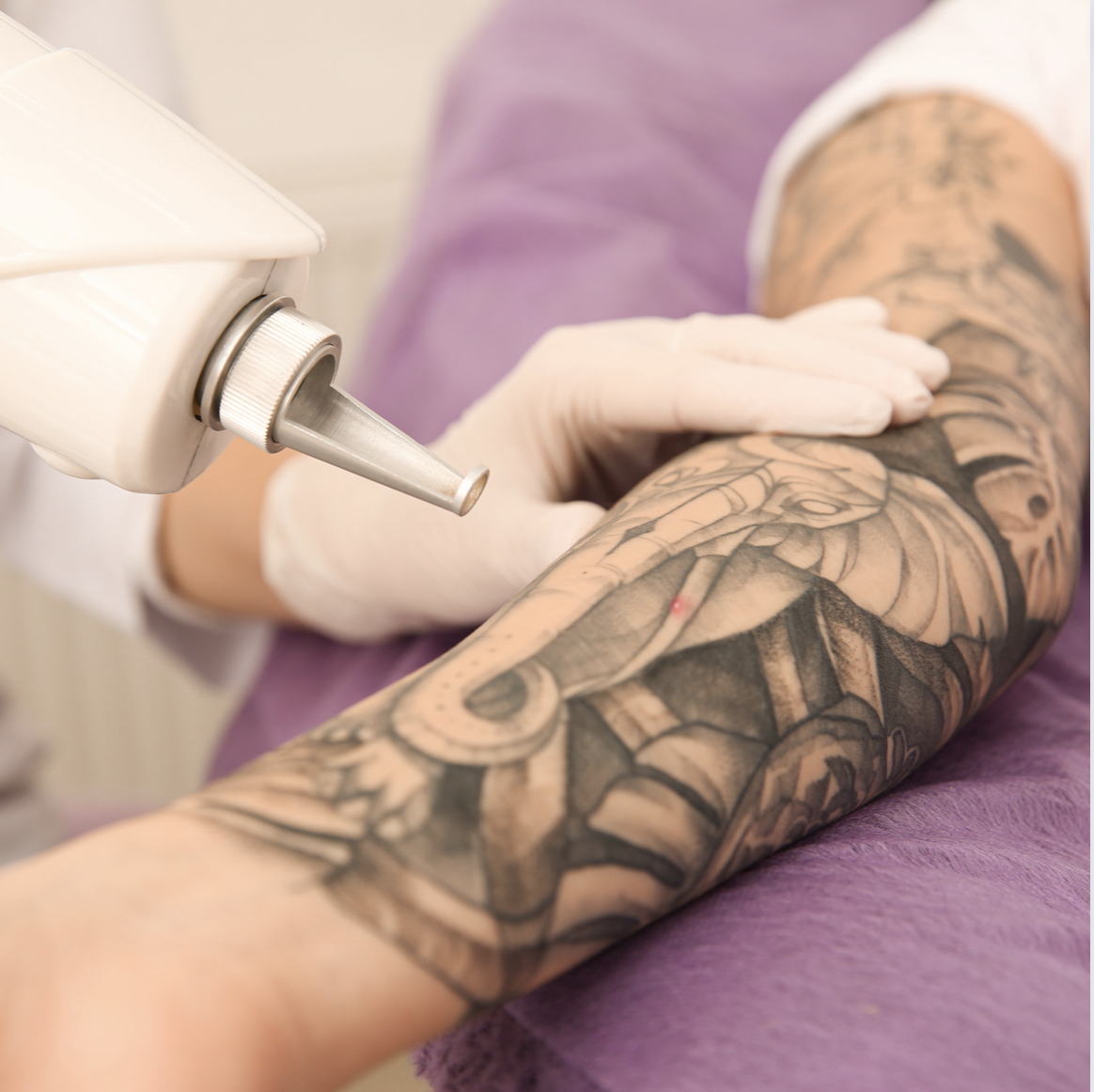 Laser Tattoo Removal | Silk and Glow Skincare | London