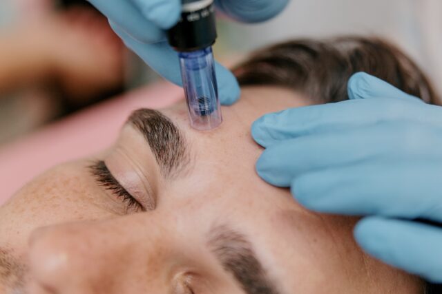 microneedling city of london