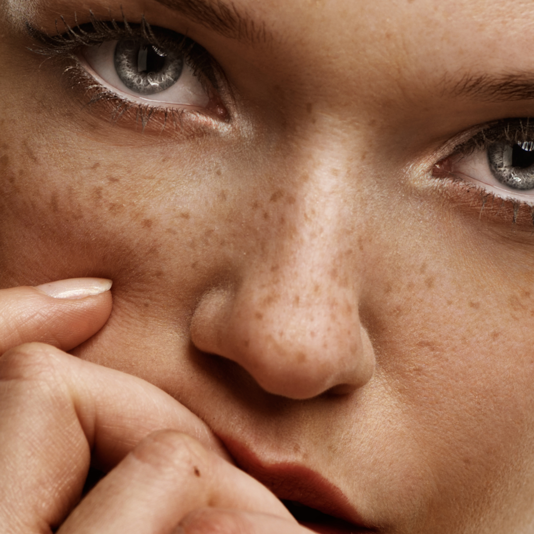 Top 3 Skin Pigmentation Treatments at Derma Revive Skin Clinic