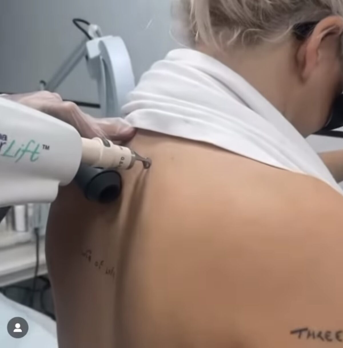 Celeb Patients: Anne-Marie visits Derma Revive Skin Clinic London for Laser Tattoo Removal