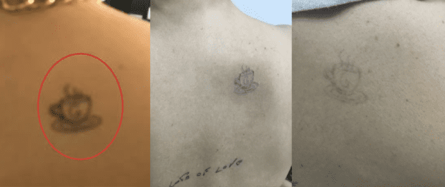 tattoo removal journey! : r/TattooRemoval