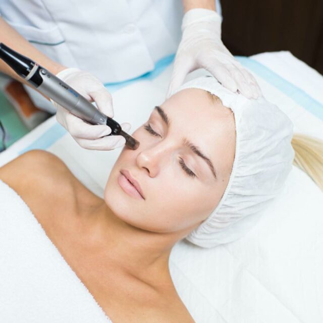Microneedling london