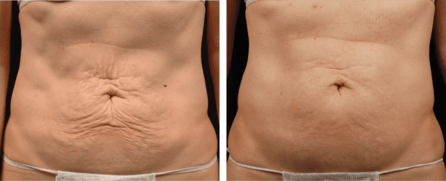 Thermage FLX before and after