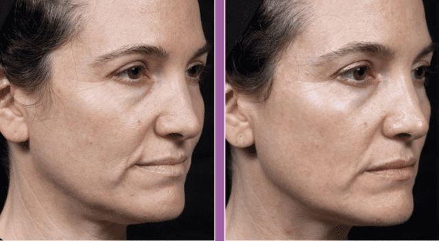 Thermage FLX before and after