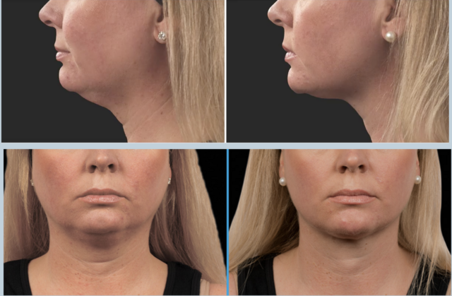 COOLSCULPTING BEFORE AND AFTER