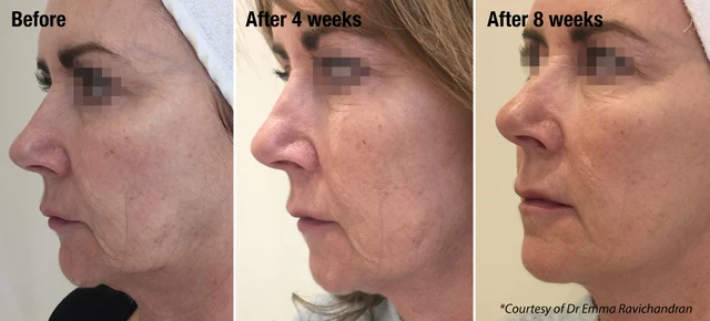 before and after profhilo pictures