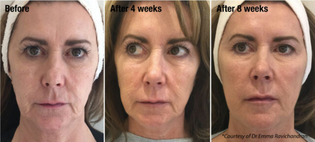 profhilo before and after