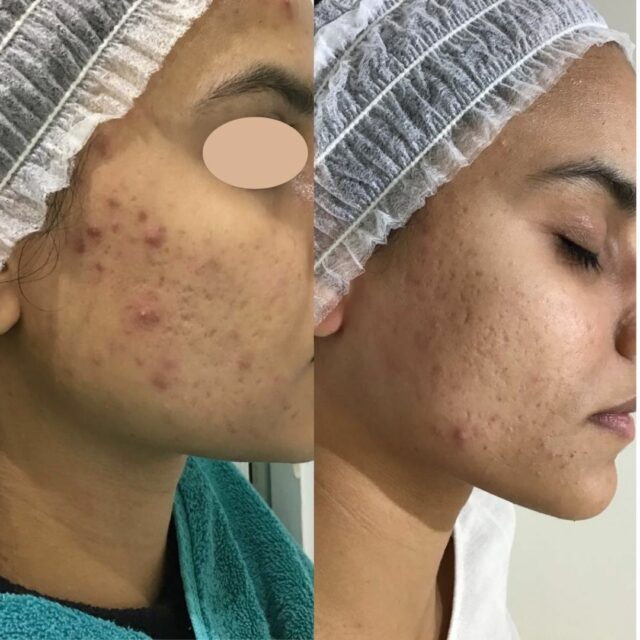 microneedling before and after