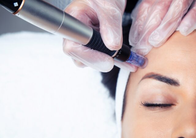 microneedling skin rejuvenation