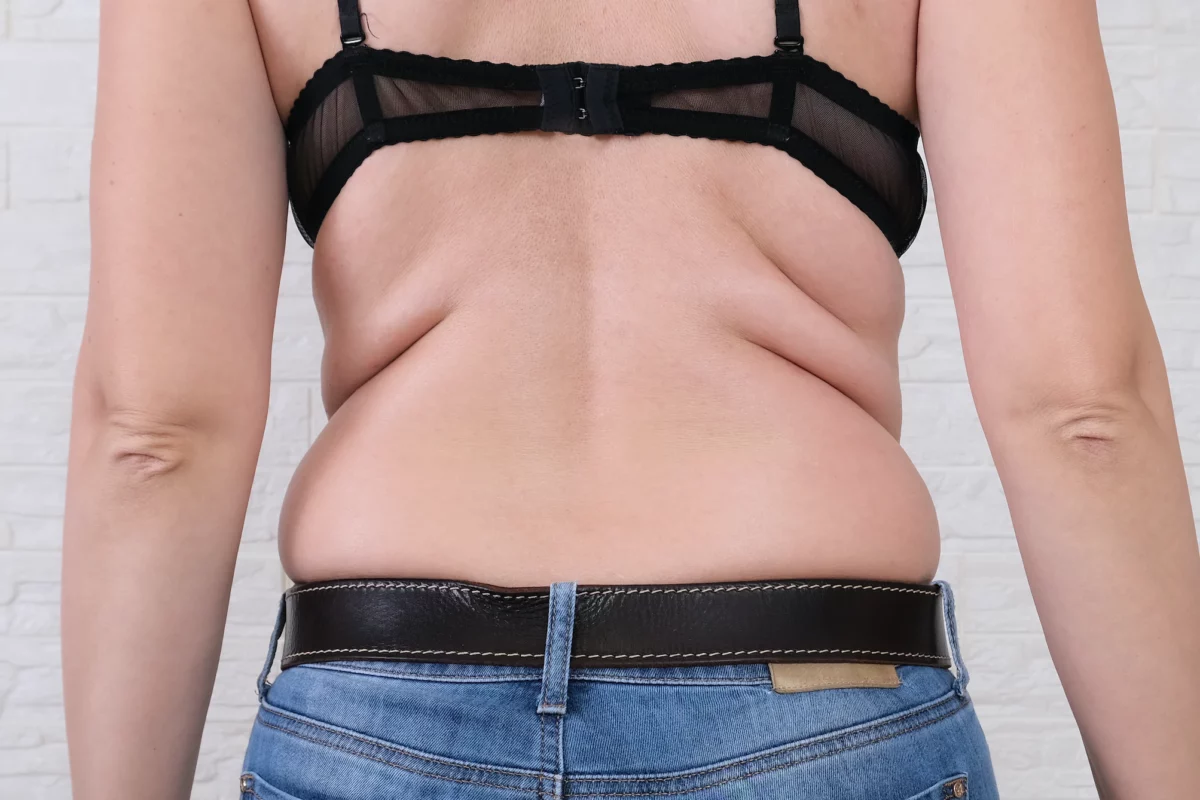 CoolSculpting for Back Fat