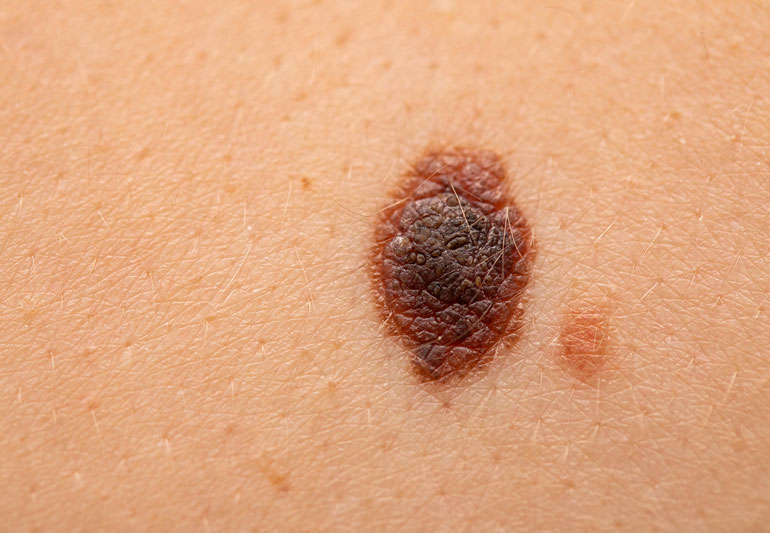 Why Choose Cosmetic Mole Removal