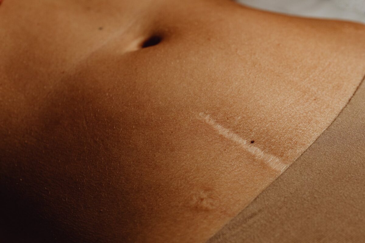 Scar Revision Surgery Image