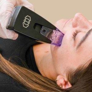 Morpheus8 face RF Microneedling treatment
