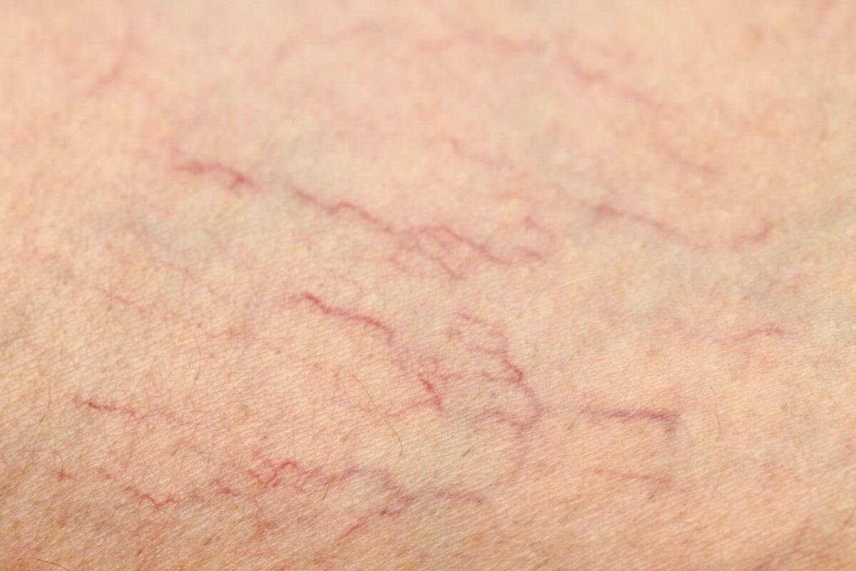 What Causes Spider Veins?