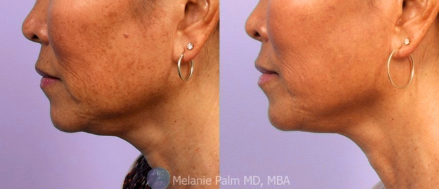 carbon peel before and after