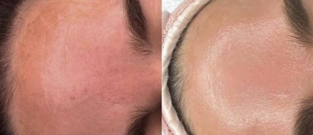 cosmelan peel before and after photos