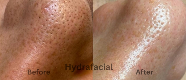 hydrafacial before and after images