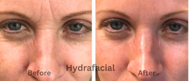 hydrafacial before and after pictures