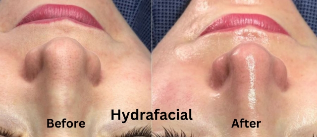hydrafacial before and after comparison