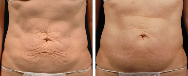 thermage body before and after