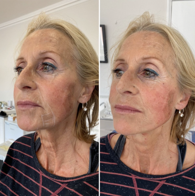 endolift