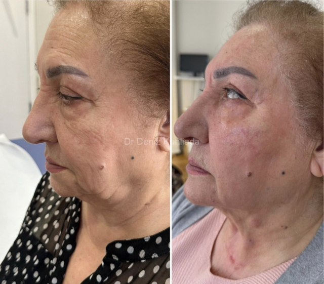 endolift face lift treatment london