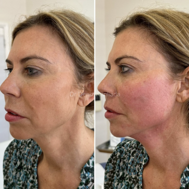 endolift face lift before and after