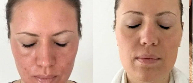 cosmelan peel before and after pictures