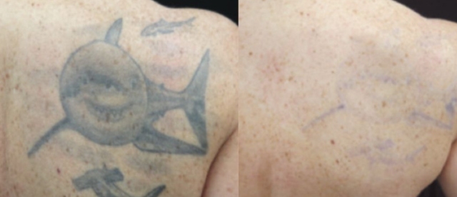 tattoo removal before and after photos