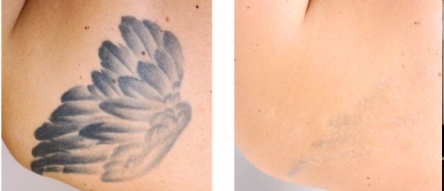 tattoo removal before and after pics