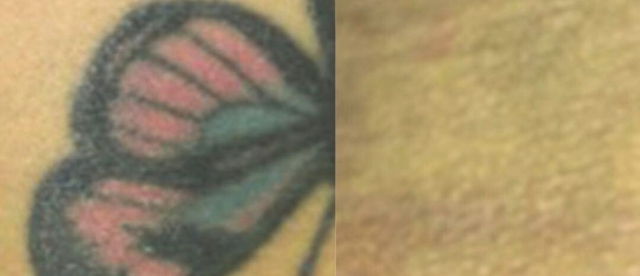 tattoo removal before and after pictures