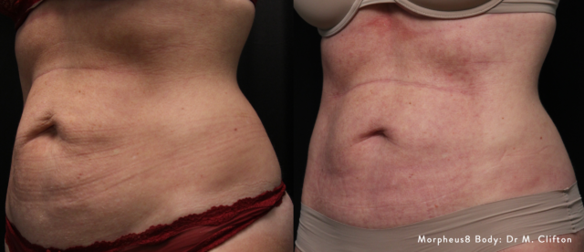 mc m8body 1b abdomen