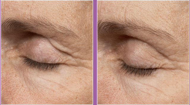 Thermage Before and after eyes