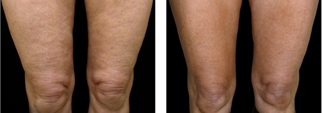 Thermage Before and after