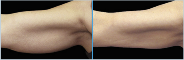 coolsculpting arm fat