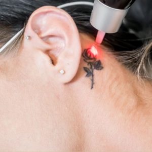 PicoSure Pro tattoo removal