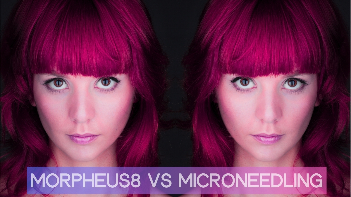 Morpheus8 vs Microneedling