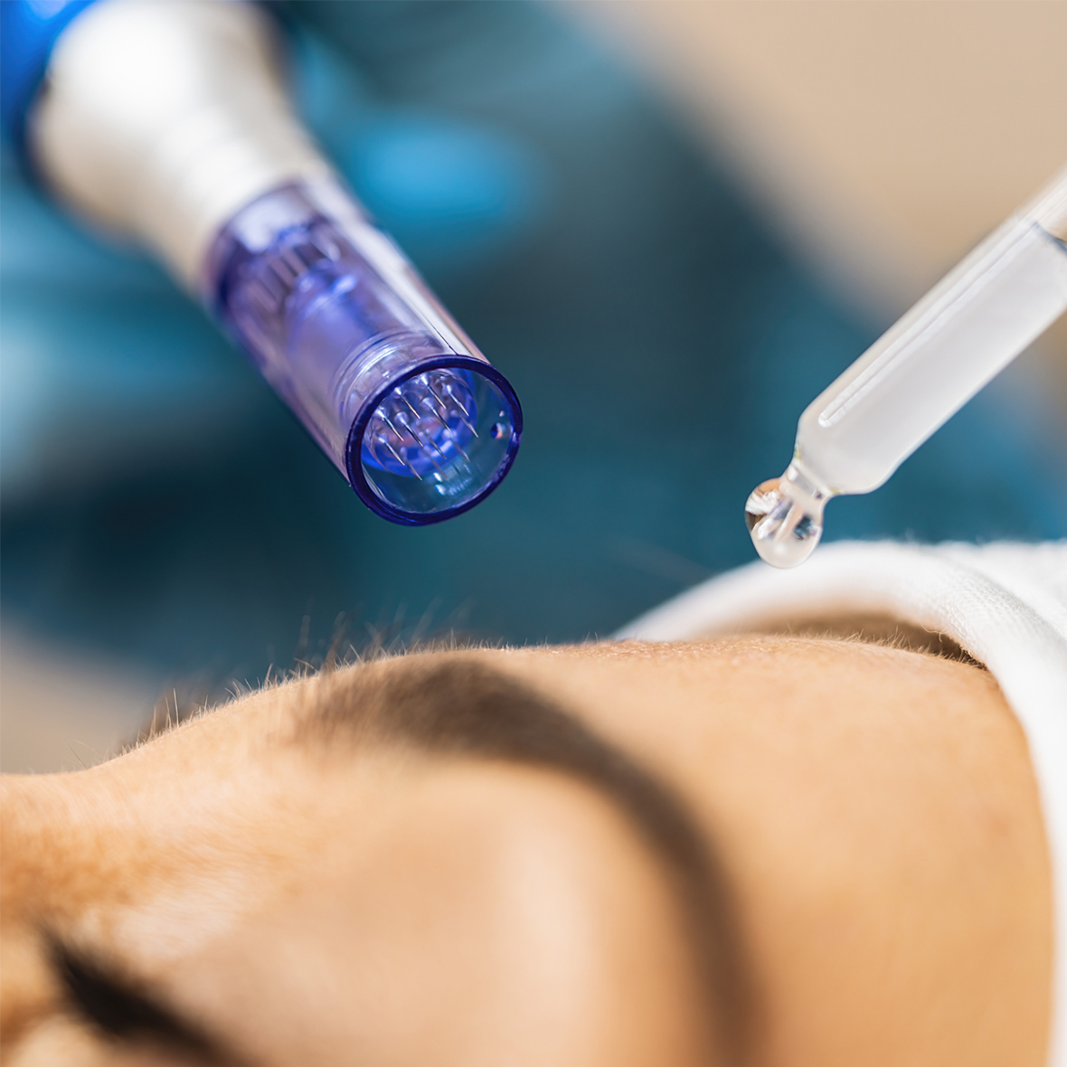 Exosomes Microneedling Treatment Image