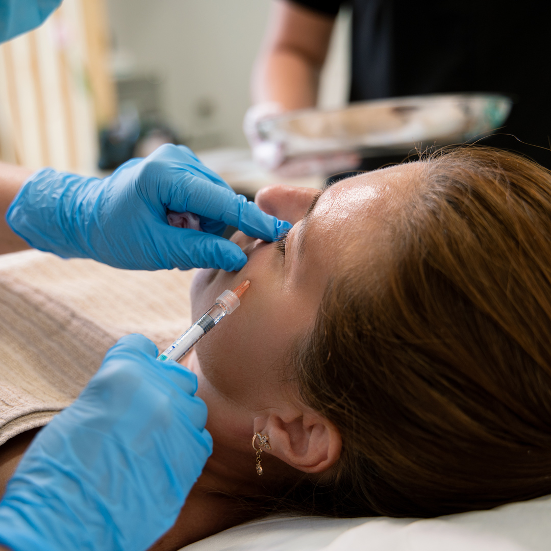Tear Troughs Fillers Image