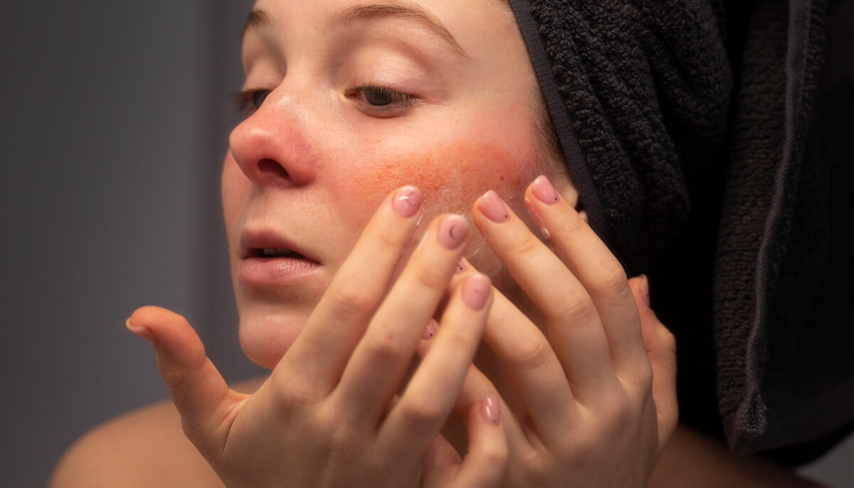 How IPL Treatments Can Help Manage Rosacea in Autumn