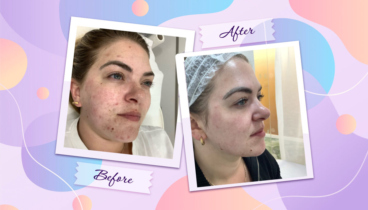 Emily’s Journey to Clearer Skin with Picosure Laser