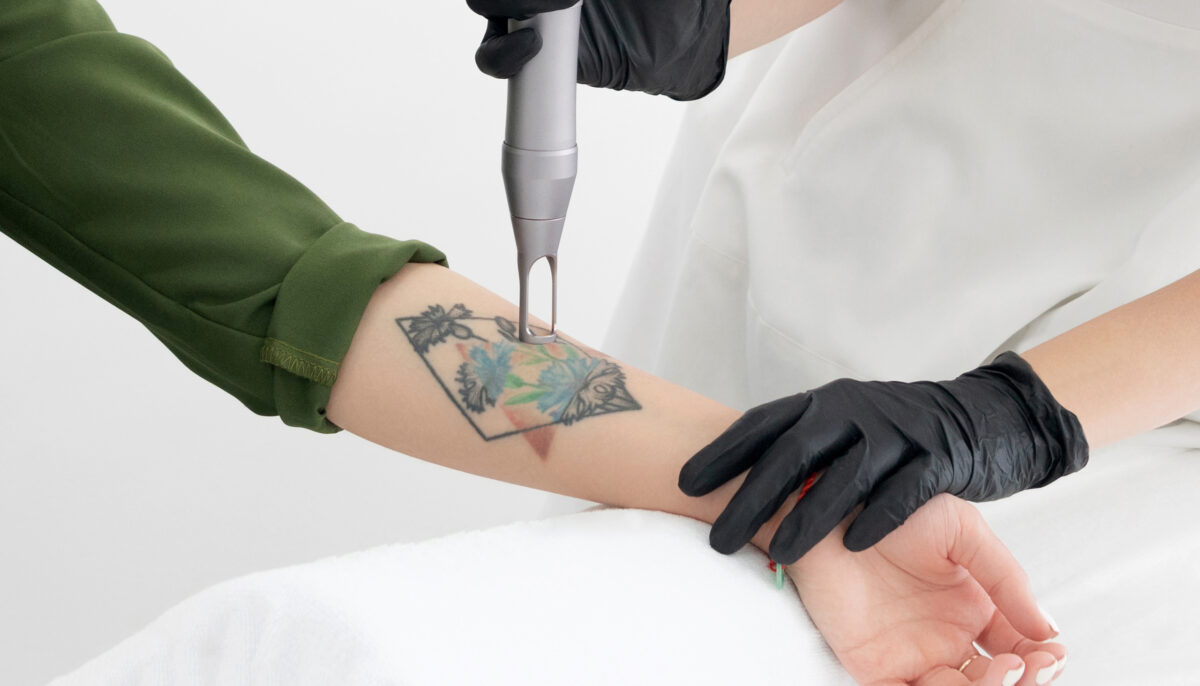 Managing Pain During Laser Tattoo Removal