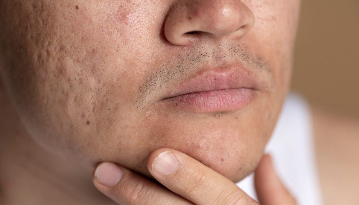 Can Acne Scars Be 100% Removed?