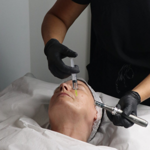 exosomes and microneedling treatment