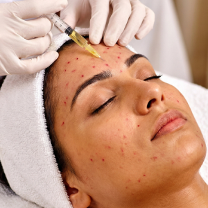 vampire facial treatment injections