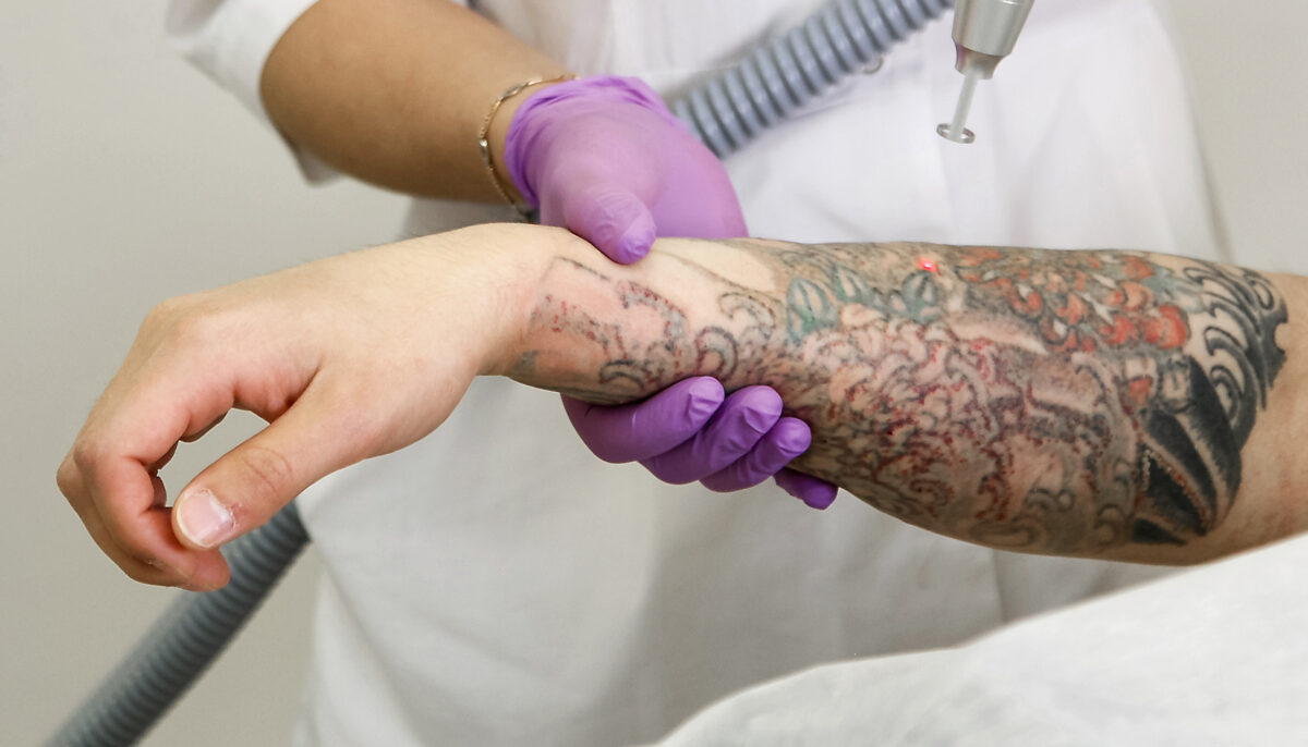 Does PicoSure Remove Black Ink?